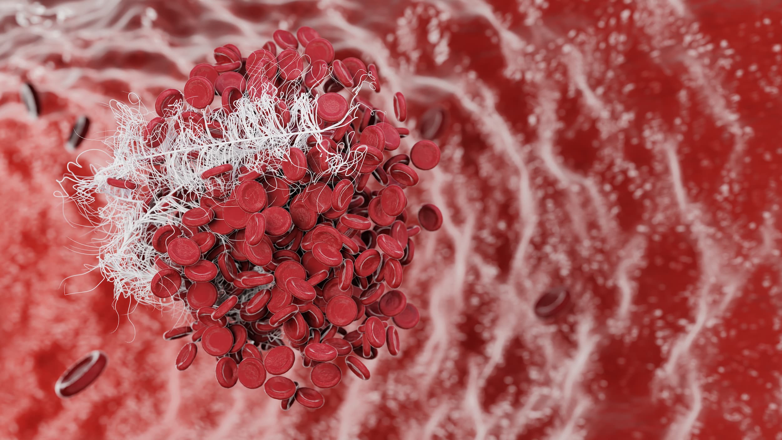 <![CDATA[FDA Approves Fesilty, Novel Agent for Acute Bleeding Episodes, in Congenital Fibrinogen Deficiency]]>