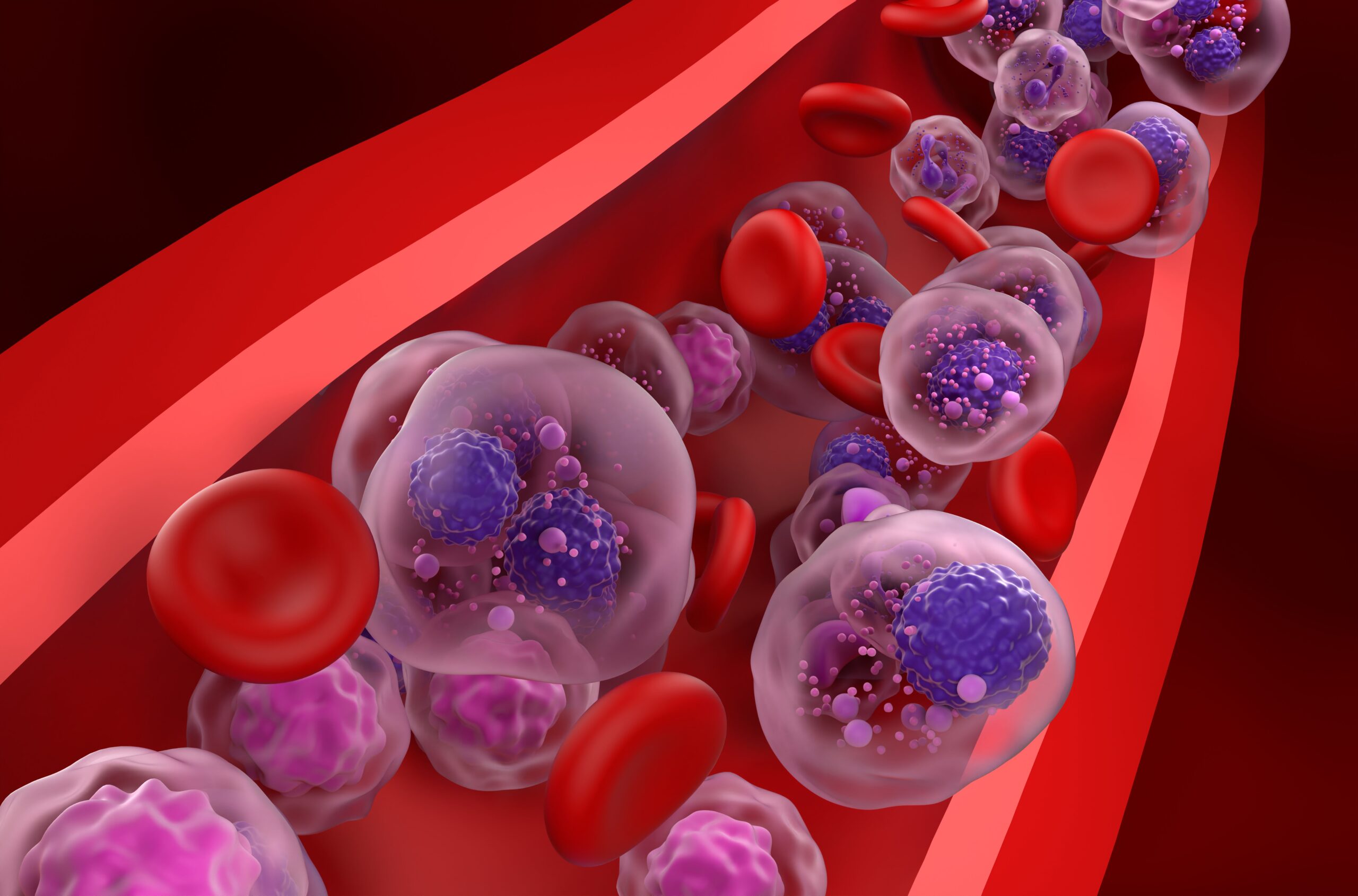 <![CDATA[High-Fiber Diet May Delay Progression of Multiple Myeloma in Patients With MGUS, SMM]]>