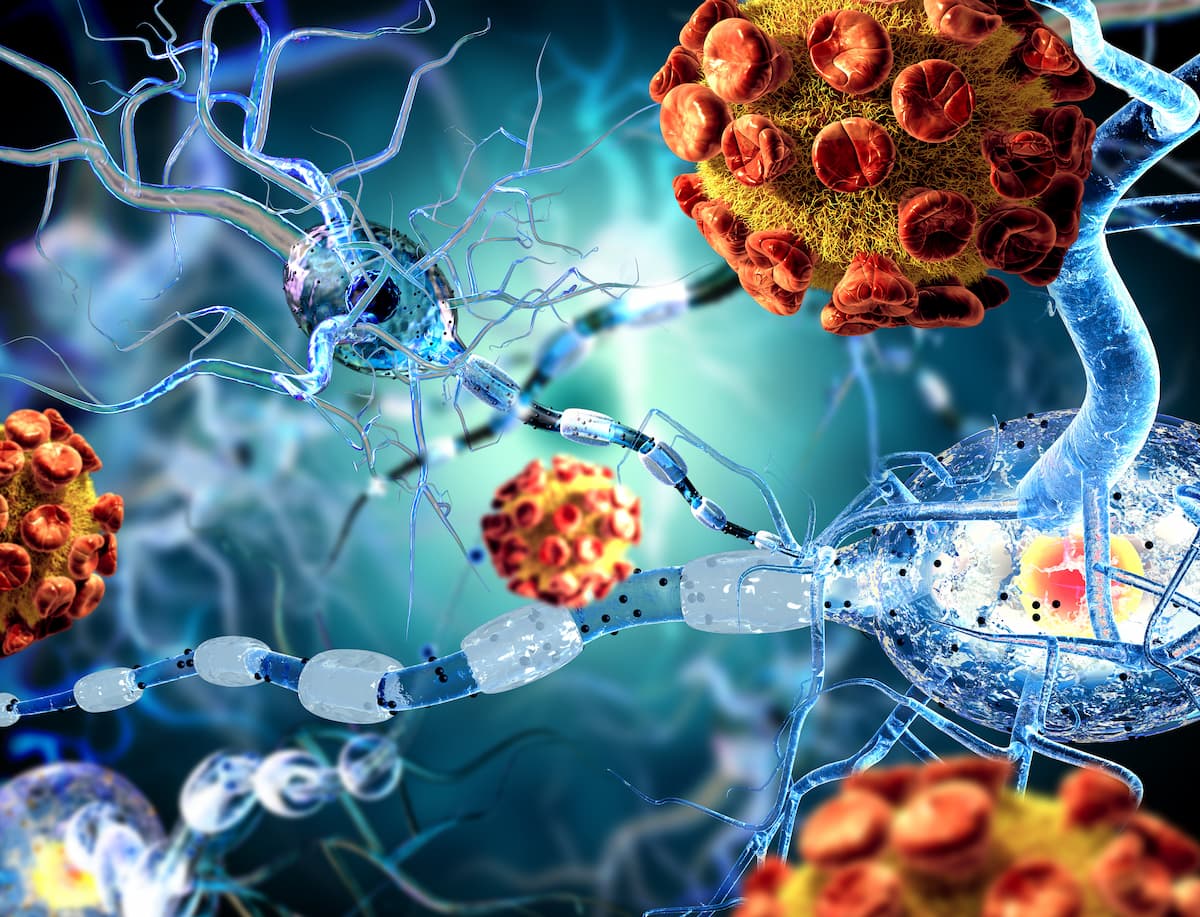 <![CDATA[Tolebrutinib Receives FDA CRL for Nonrelapsing Secondary Progressive Multiple Sclerosis]]>